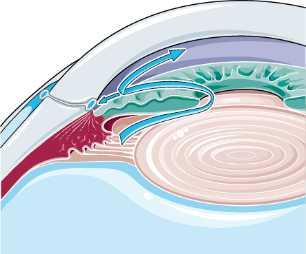 Diagrama do glaucoma de ângulo aberto