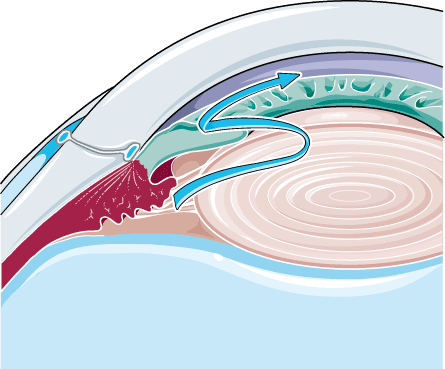Diagrama do glaucoma de ângulo fechado